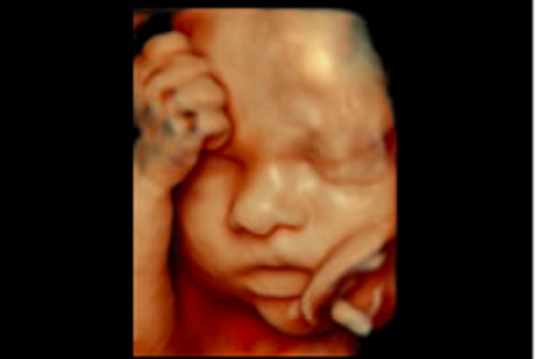 胎児超音波スクリーニング - あまがせ産婦人科 院内ブログ